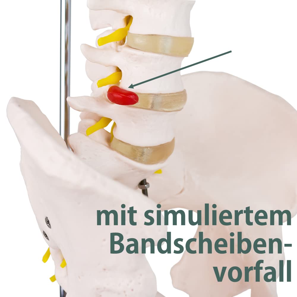 Anatomie Modell Skelett mit Bandscheibenvorfall
